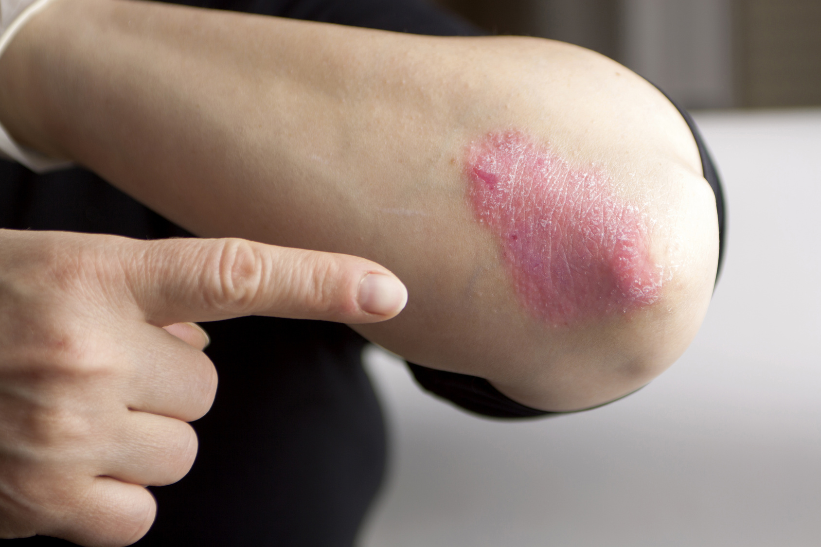 This New Drug Could Help Psoriasis Sufferers