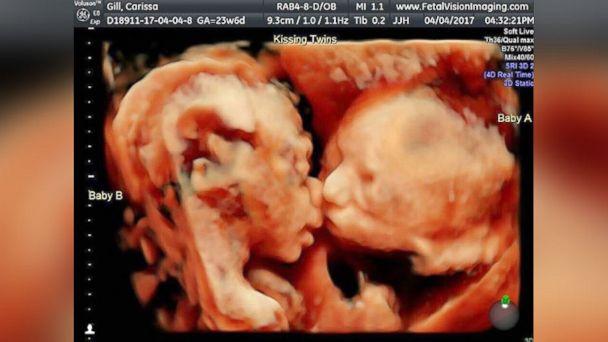 Ultrasound Shows Moment Twins Appear To Be Kissing In Womb 3568