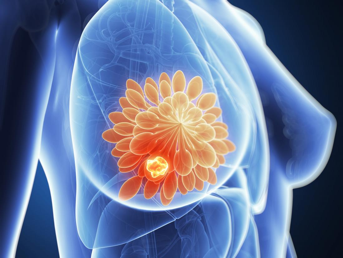 FDA Grants Accelerated Approval for Roche Holdings Tecentriq Drug for Breast Cancer